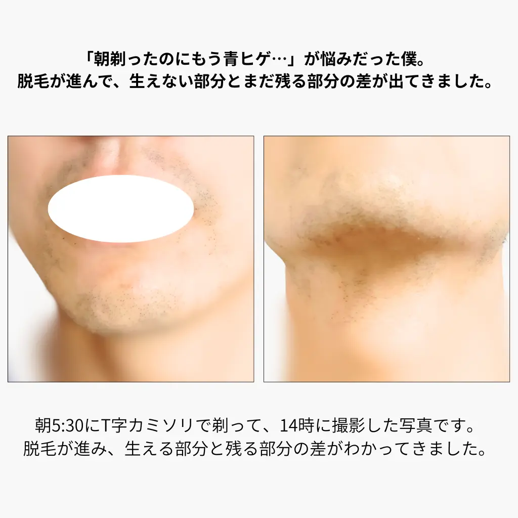 朝5時半に剃ったヒゲが14時には青髭になってしまう様子と、脱毛で生えなくなった部分の比較写真