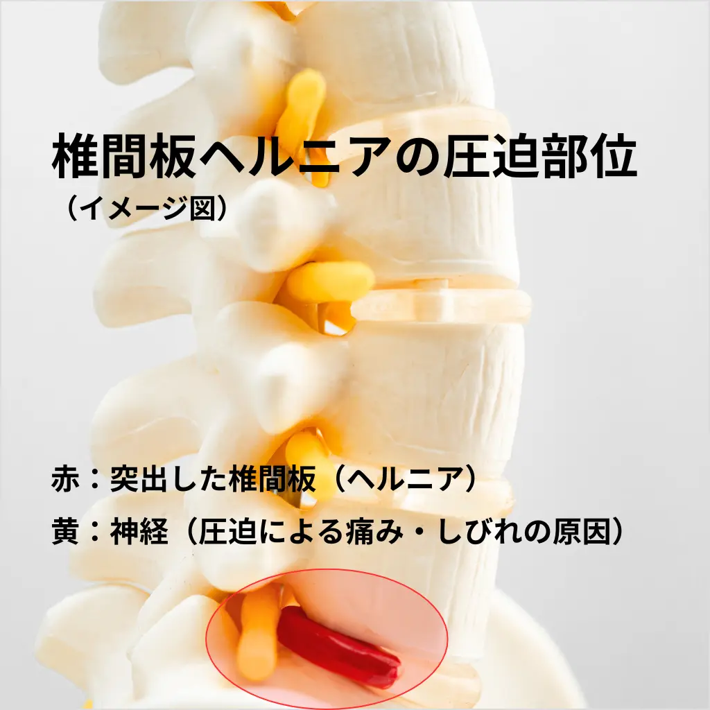 椎間板ヘルニアで神経が圧迫される部位を示したイメージ図（赤が突出した椎間板・黄が神経）