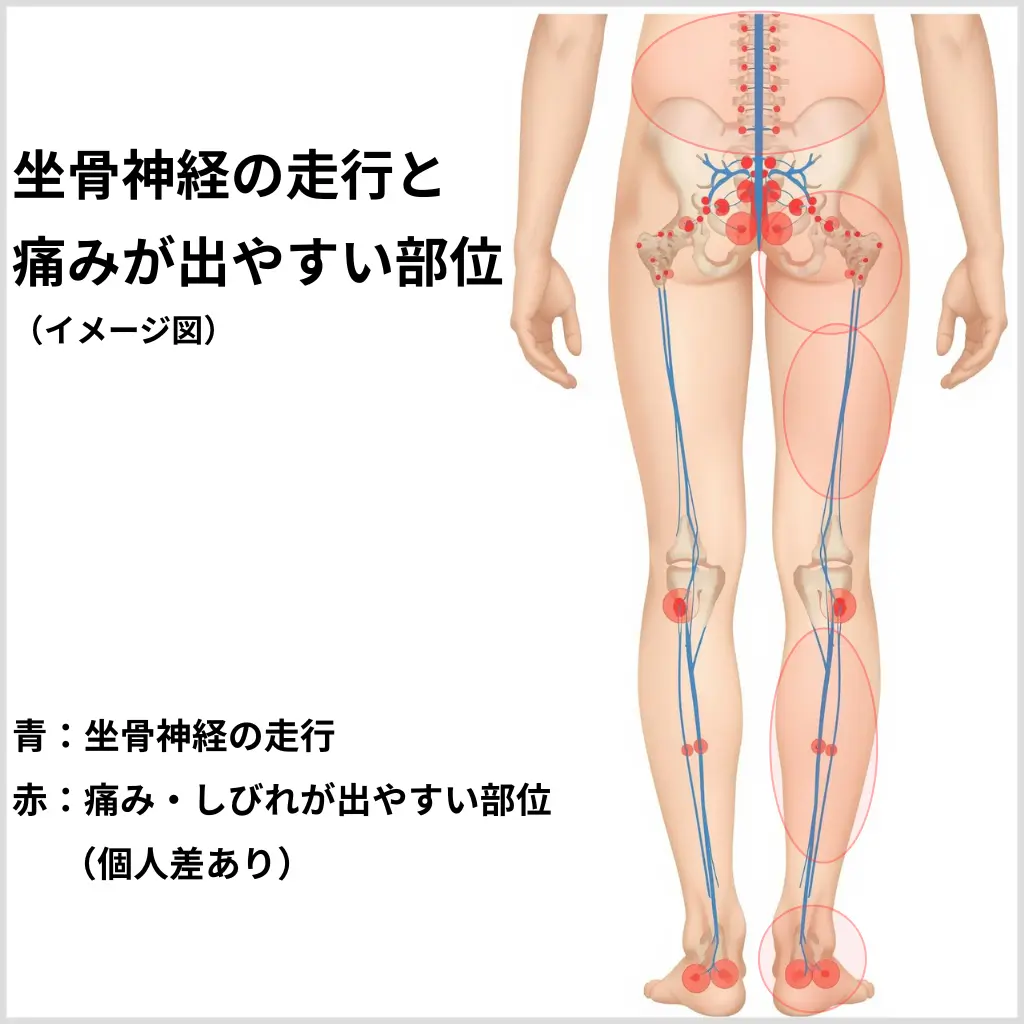 坐骨神経の走行と、痛み・しびれが出やすい部位を示したイメージ図（腰から足先までの神経の通り道）